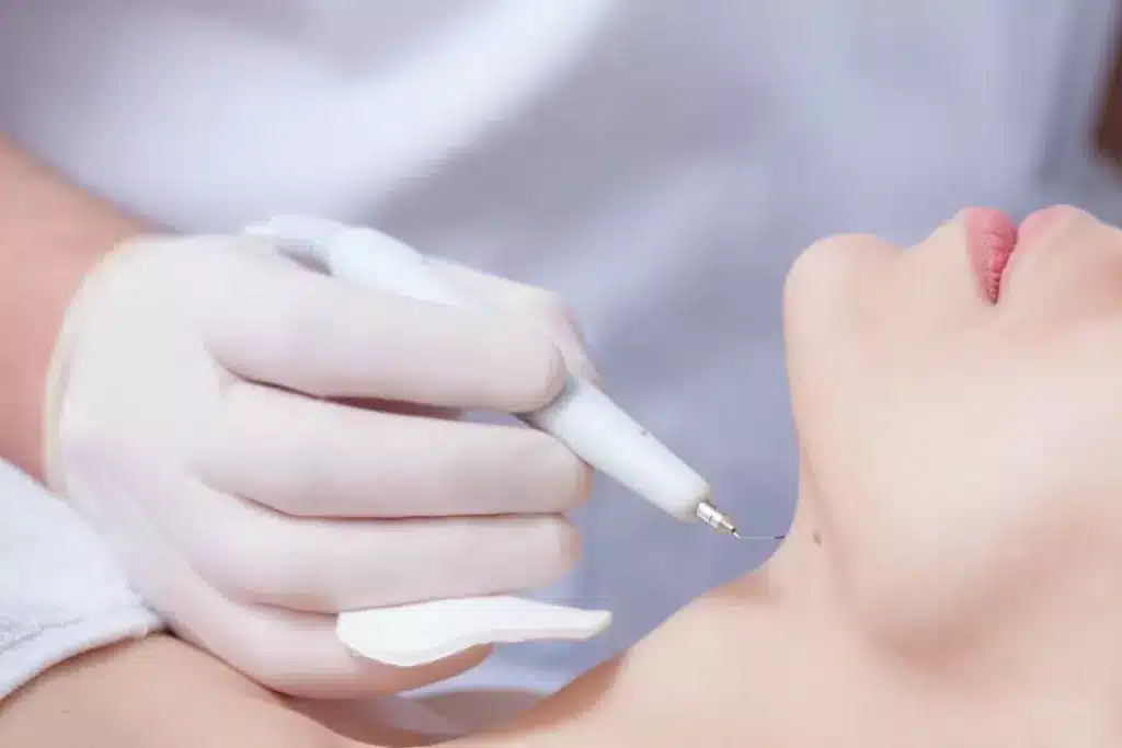 how fast is recovery after warts removal treatment