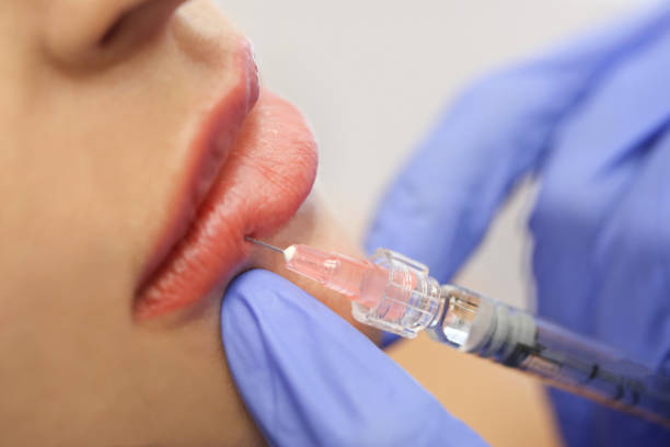 Does Lip Filler Work Well for Mature Skin and Aging Lips