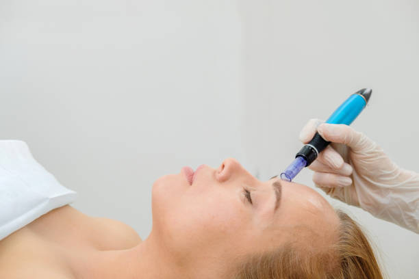 What Results Can You Expect From microneedling Treatments