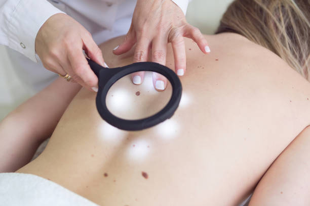 Can Warts Removal Treatment Remove Stubborn Warts