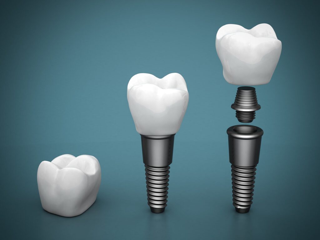Dental Implants in Cudahy