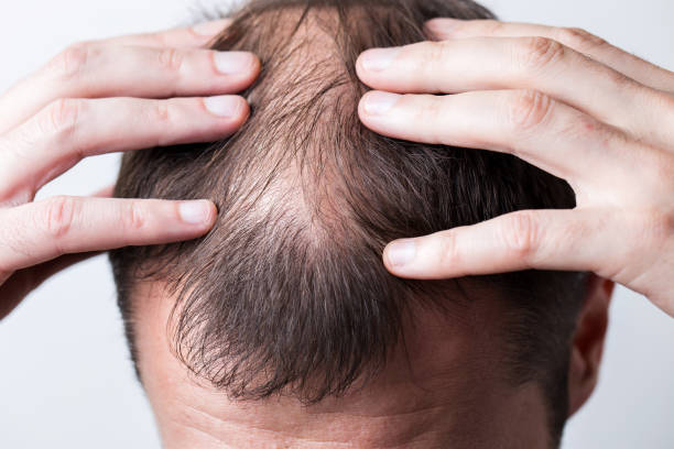 Is Hair Loss Treatment Safe for Sensitive Scalps