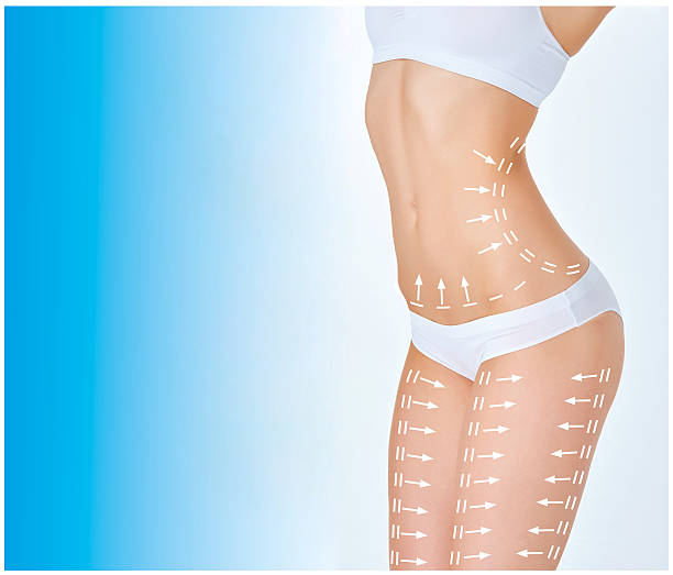 Liposuction in Riyadh