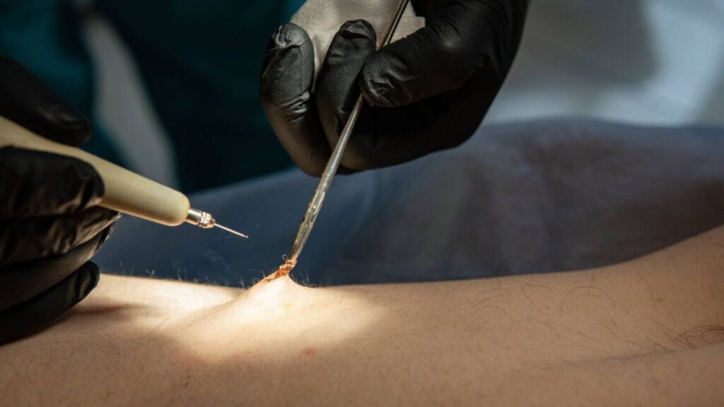 How Long Does Laser (EPSiT) Pilonidal Surgery Take to Heal » Services ...